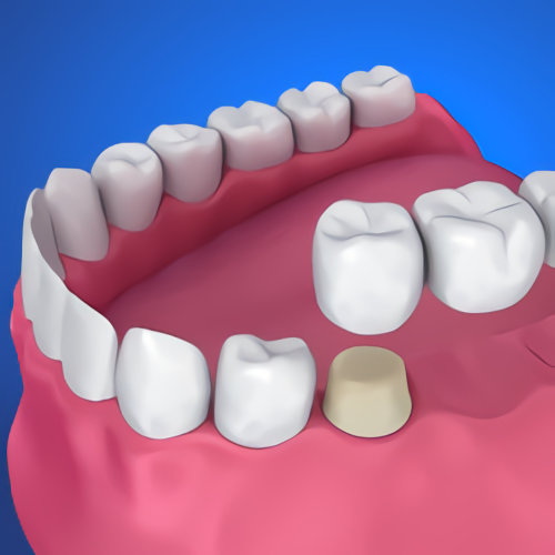 Dental Bridges