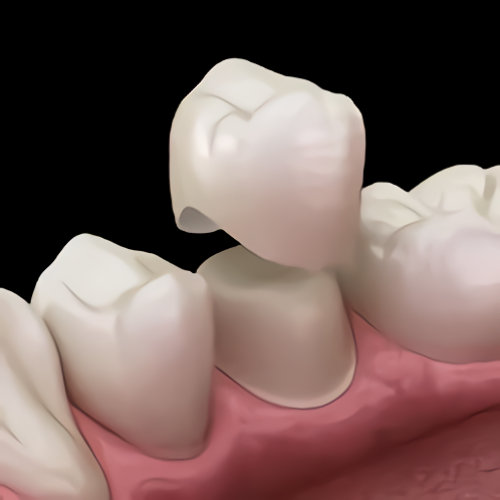 Dental Crowns