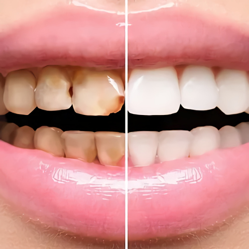 Cosmetic Veneers