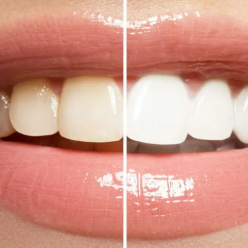 Teeth Whitening